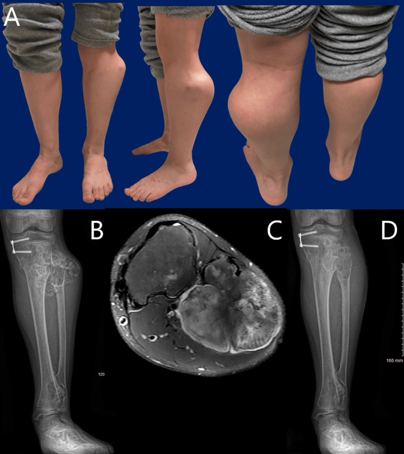 New Study Evaluates Peroneal Nerve Decompression in Multiple Hereditary ...