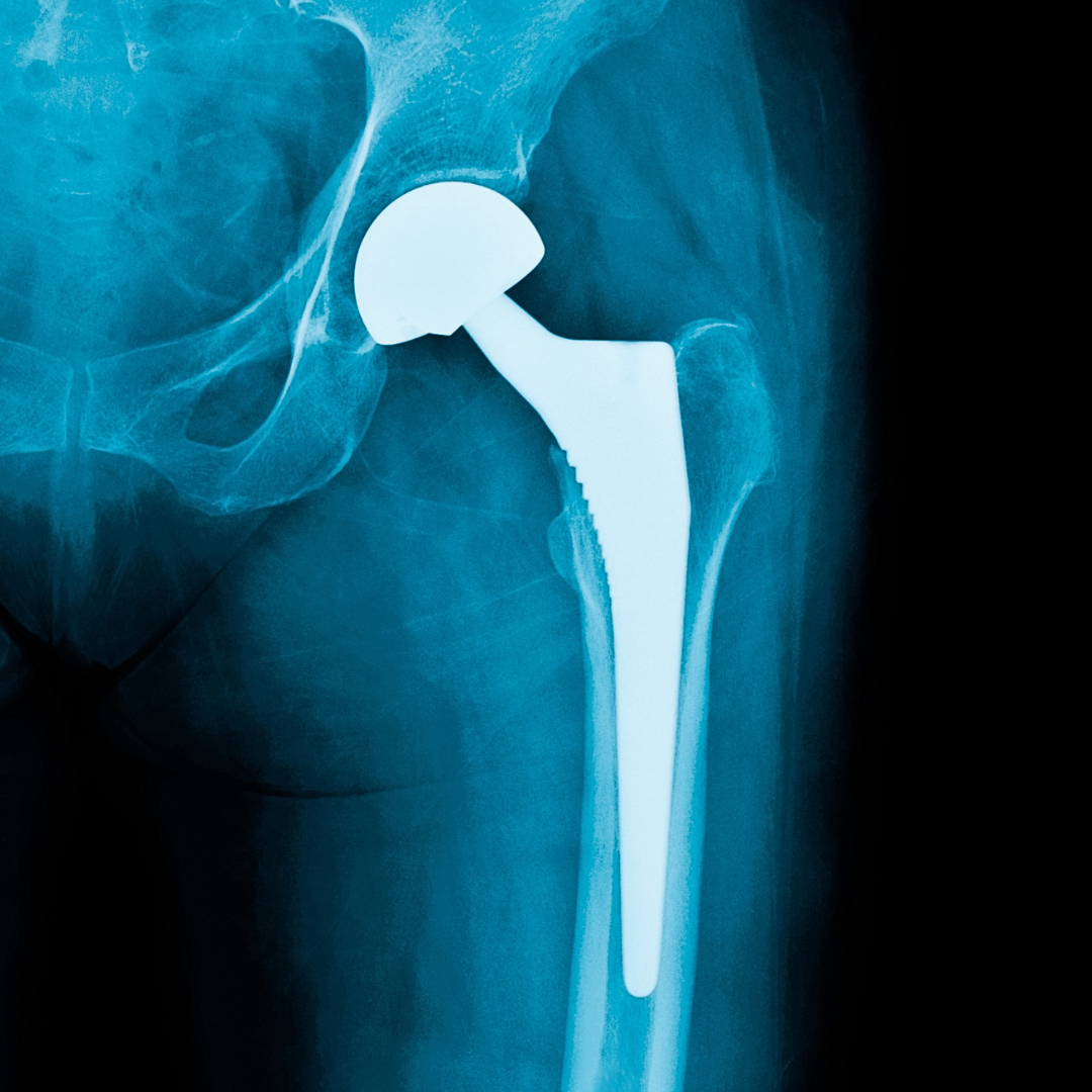 Radiograph of a hip replacement.