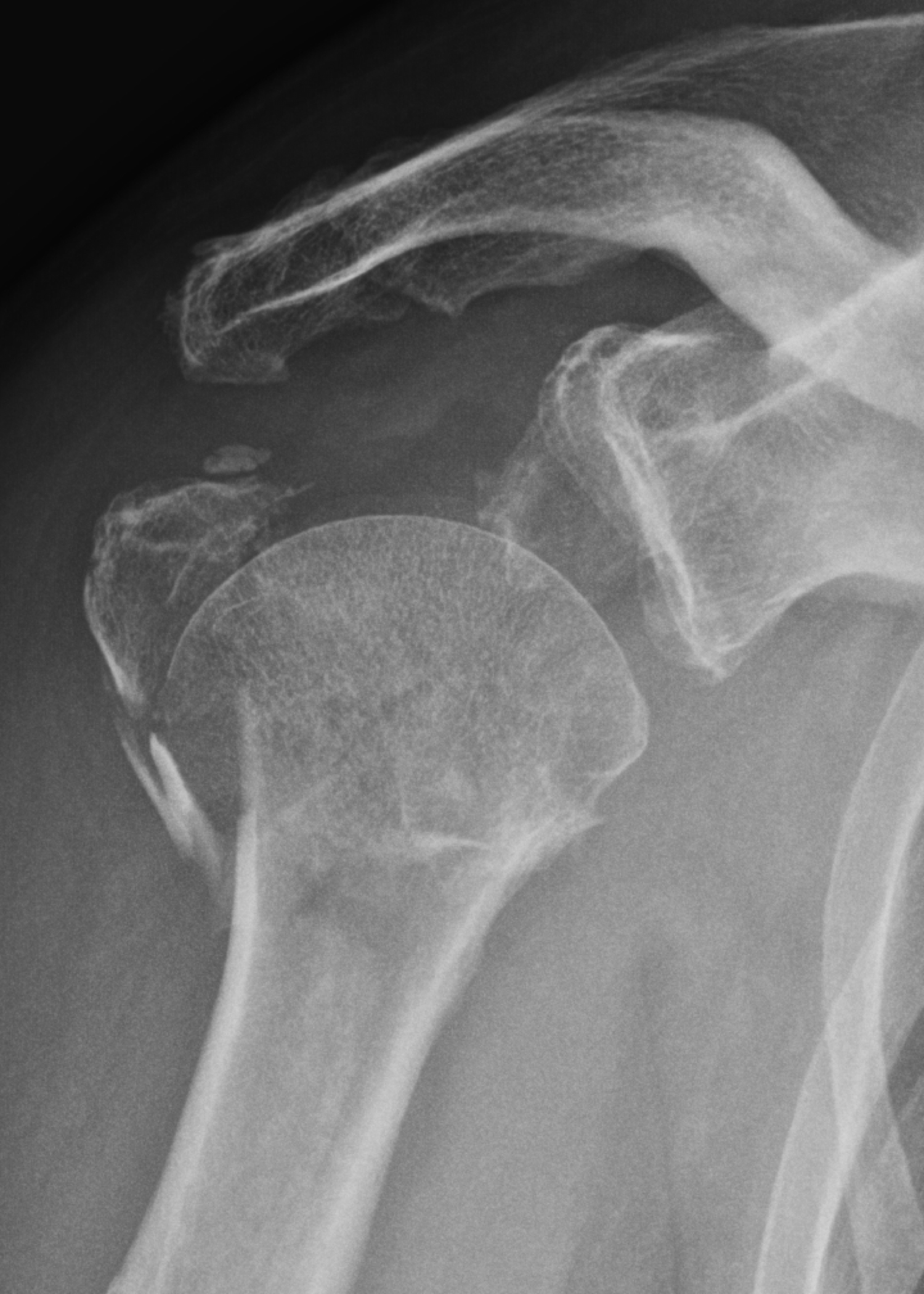 True anteroposterior radiograph showing a 4-part valgus impacted AO/OTA type-C2 proximal humeral fracture.