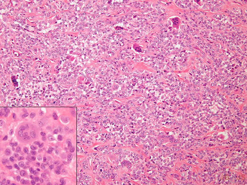 Histological features of tenosynovial giant cell tumor.