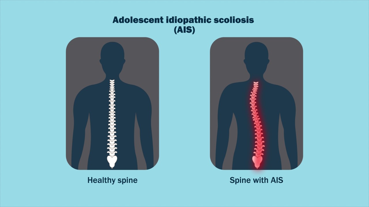 Illustration depicting the appearance of a normal spine versus a spine with adolescent idiopathic scoliosis.