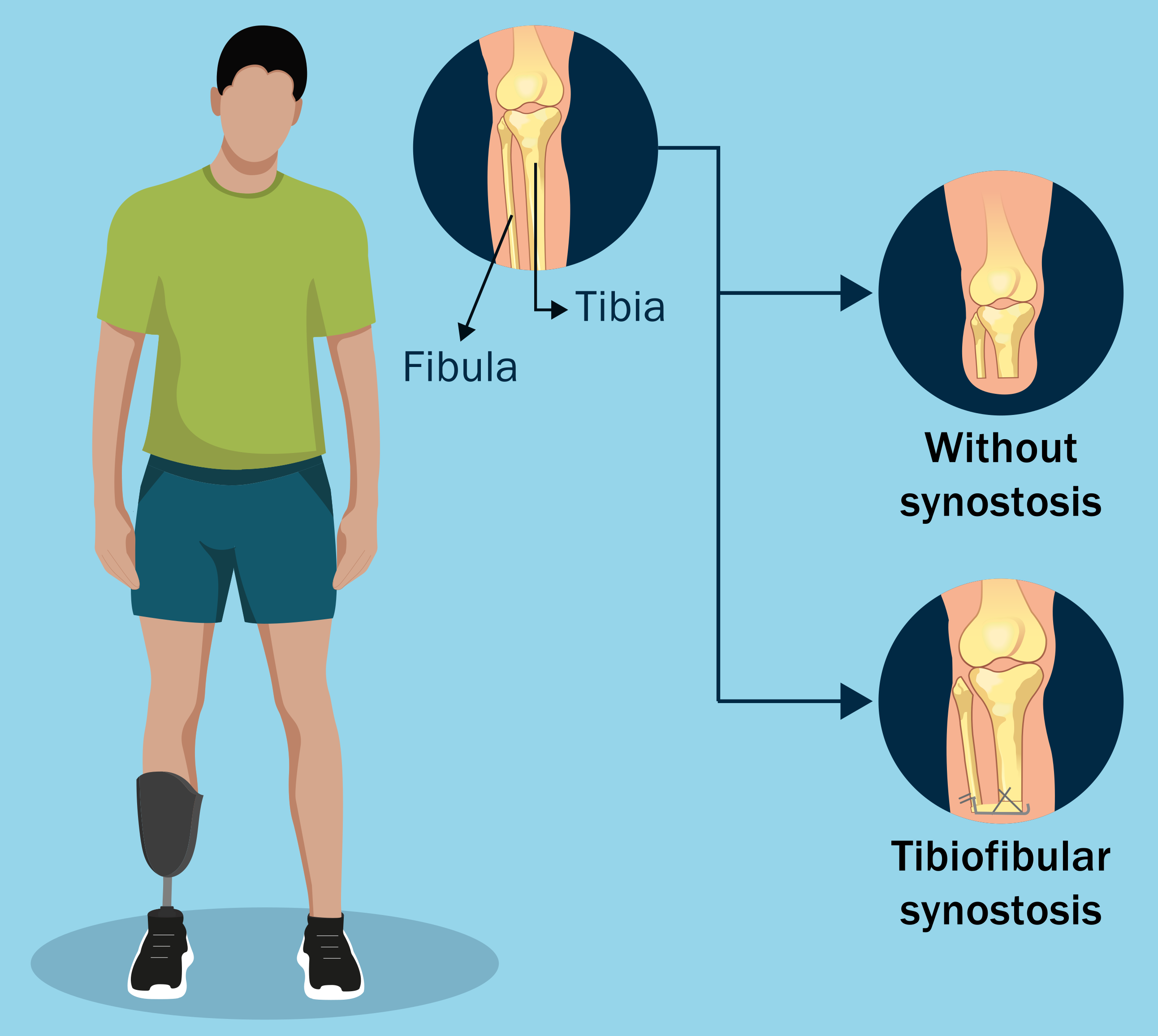 Illustration depicting the patient randomization for "Outcomes Following Transtibial Amputation with and without a Tibiofibular Synostosis Procedure A Multicenter Randomized Clinical Trial (TAOS Study)" by METRC.