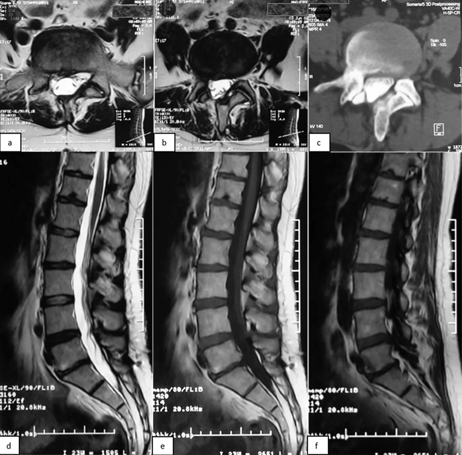 Preoperative MRI scans showing compression on the right side, a black collapsed disc at L4-L5, and T1 and T2 signal hyperintensity (early Modic type 2), and a preoperative computed tomography myelogram showing foraminal compression and a right-sided partial facet defect, in a 45-year old female with a prior L5-S1 laminotomy who underwent 2-level total disc arthroplasty in the present study.