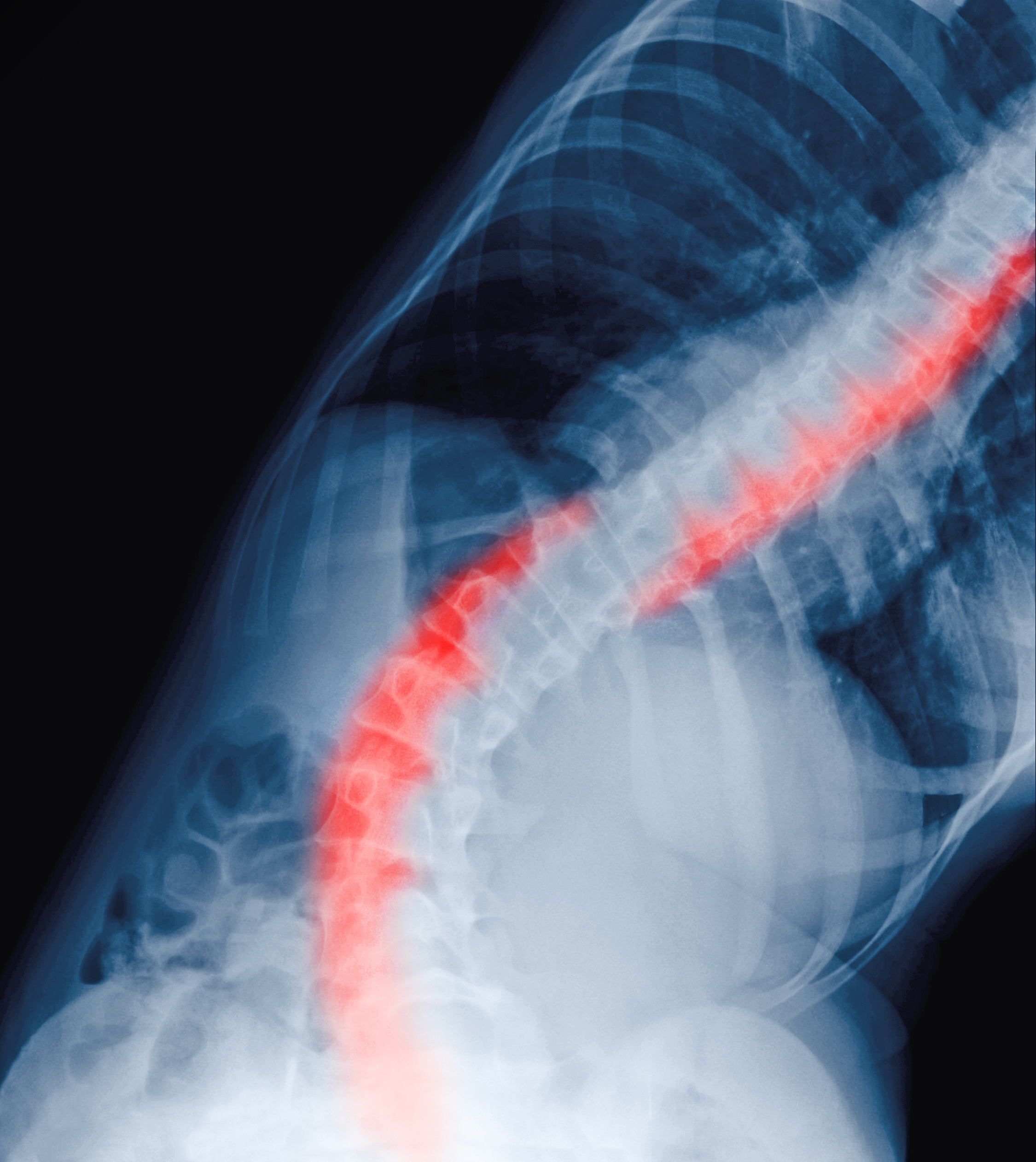 Radiograph of pediatric scoliosis.