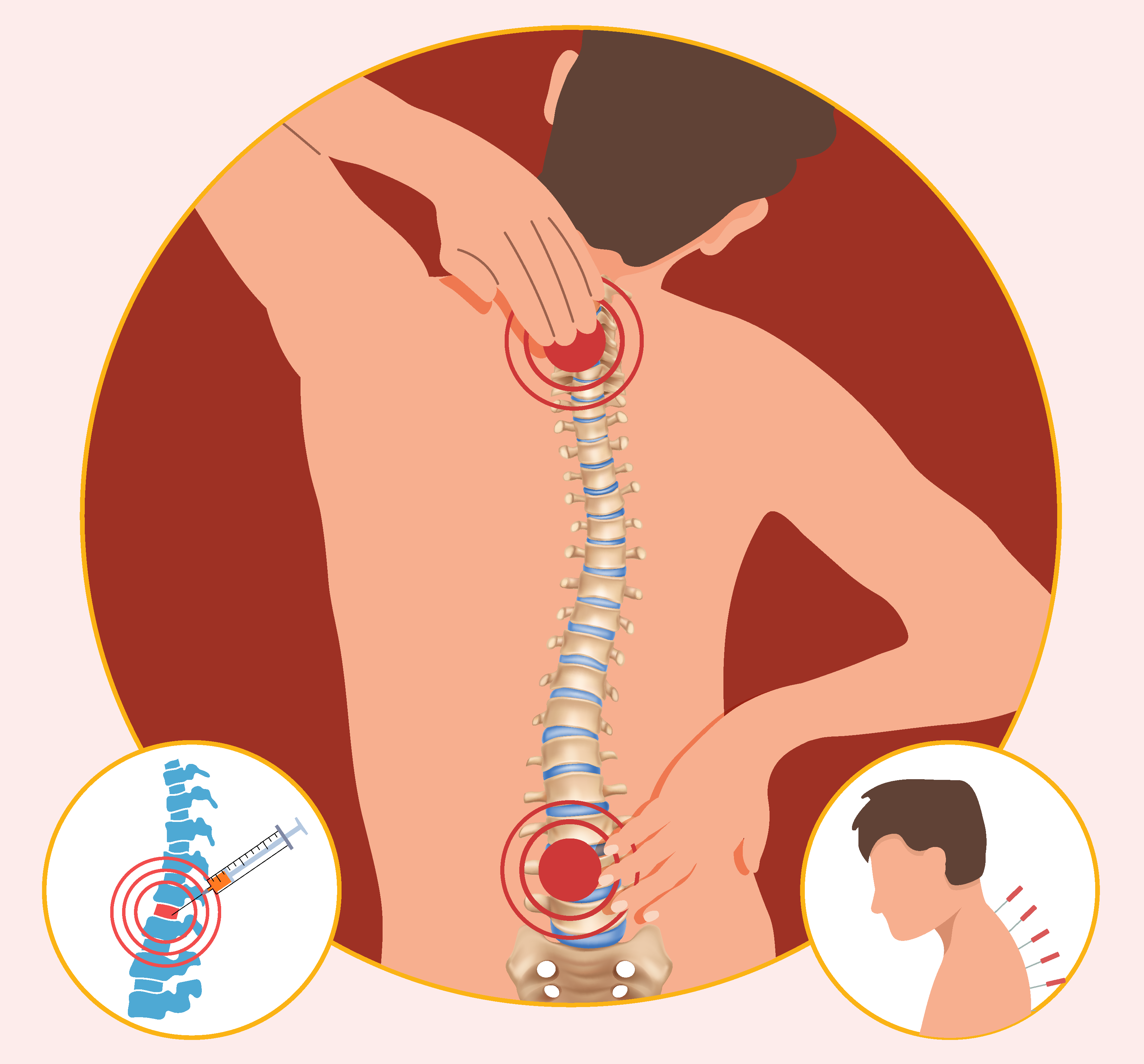 Illustration depicting spine pain, preoperative acupuncture, and epidural steroid injection treatments.