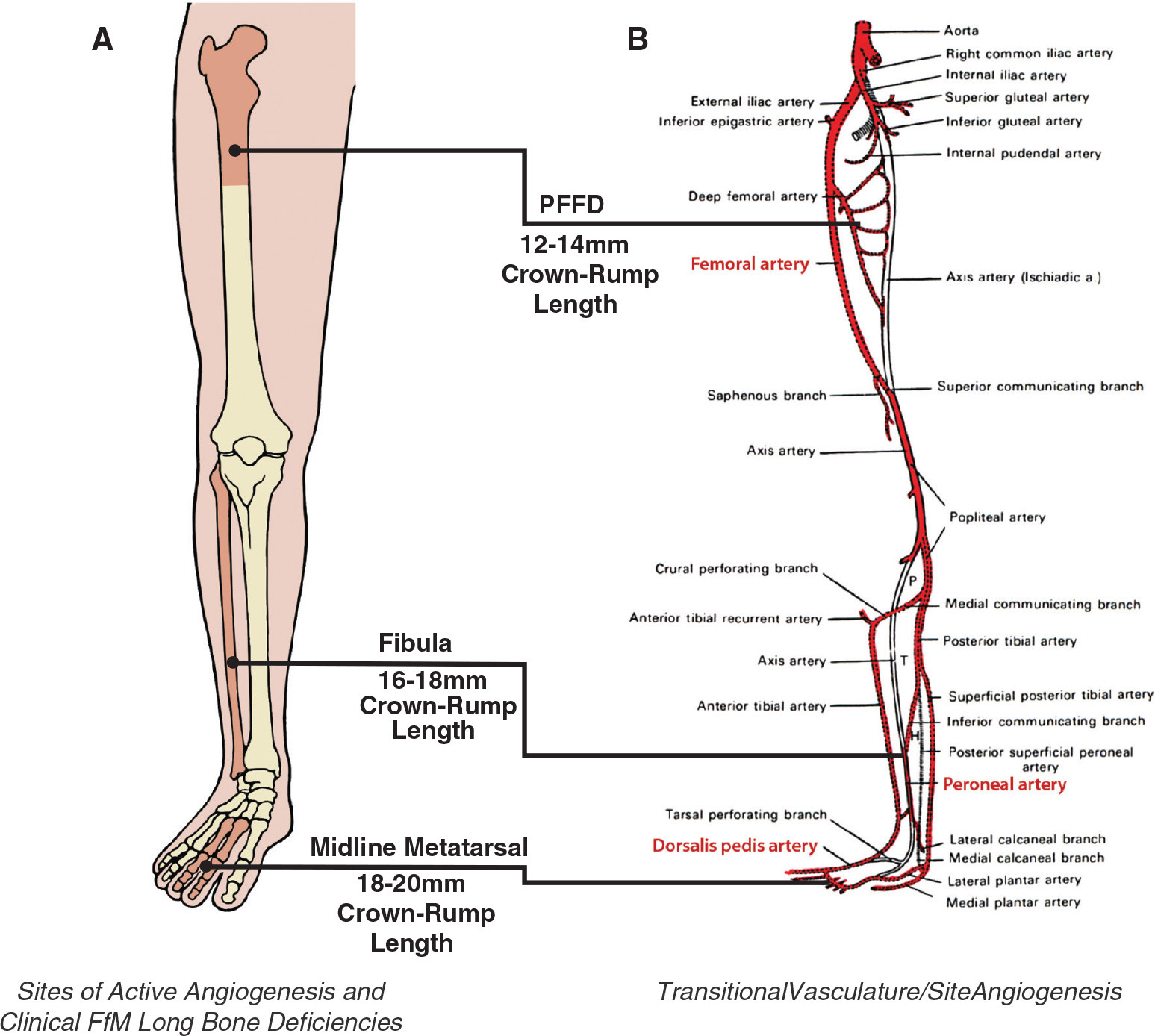 Diagram of congenital long bone deficiencies of the human lower limb and the stages of arterial development.