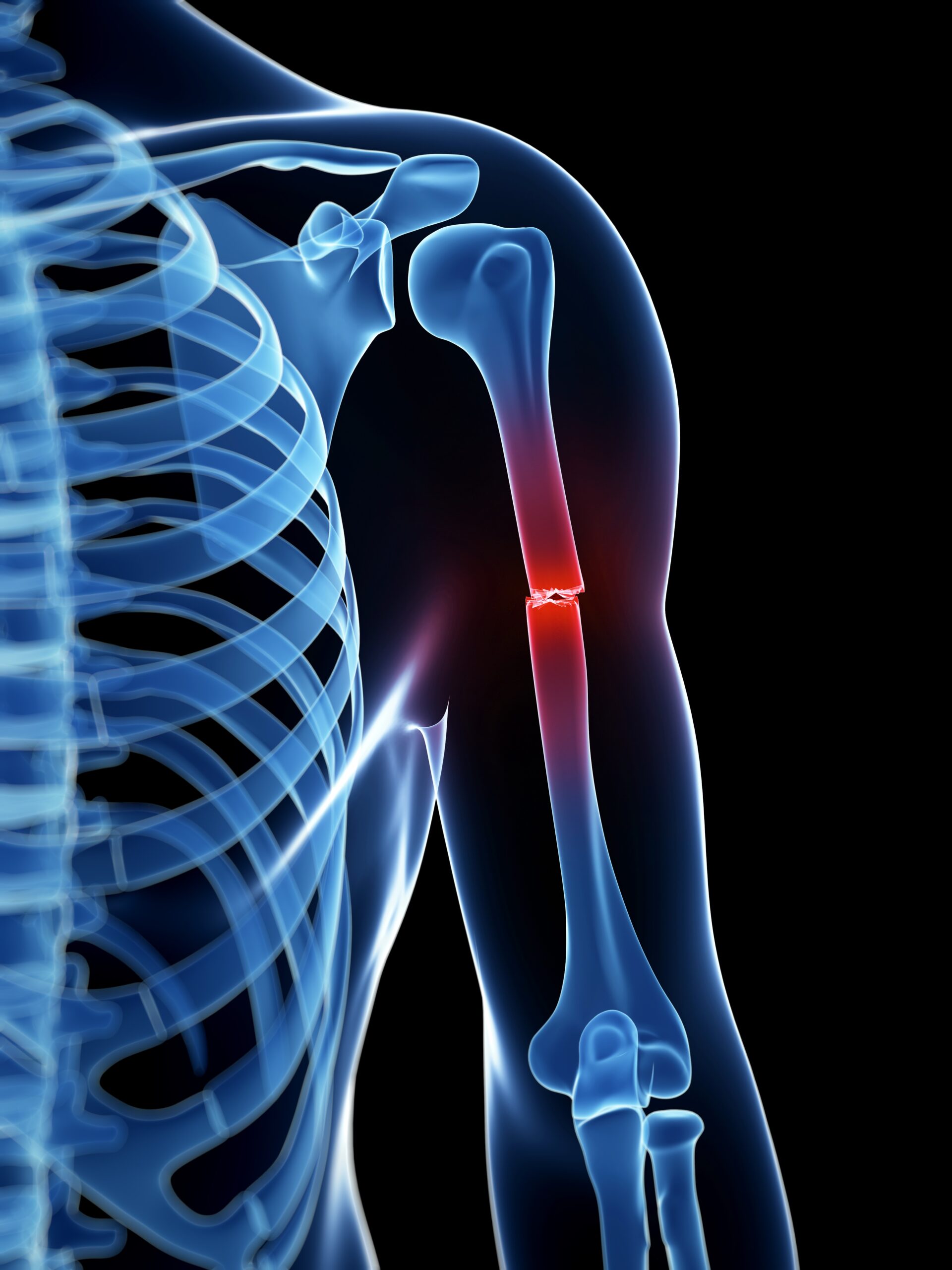 Illustration depicting trauma to the humerus.