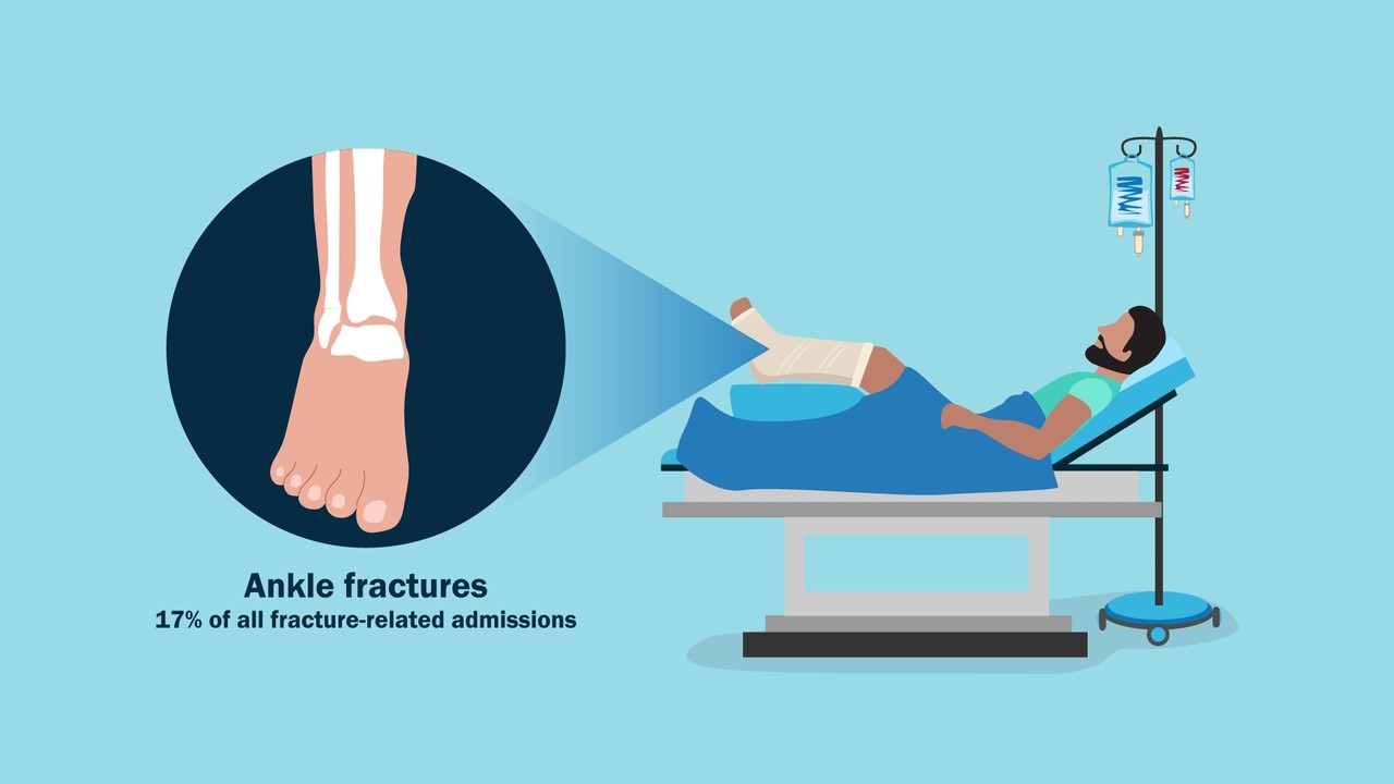 Illustration depicting ankle fracture