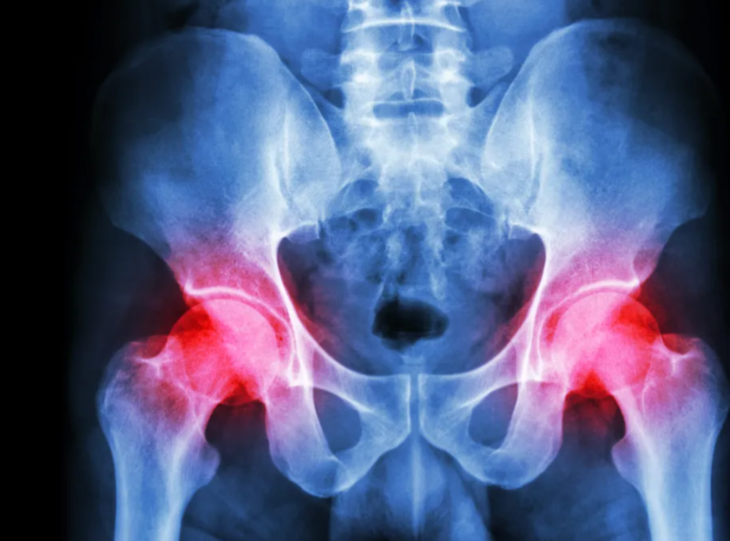 hip radiograph