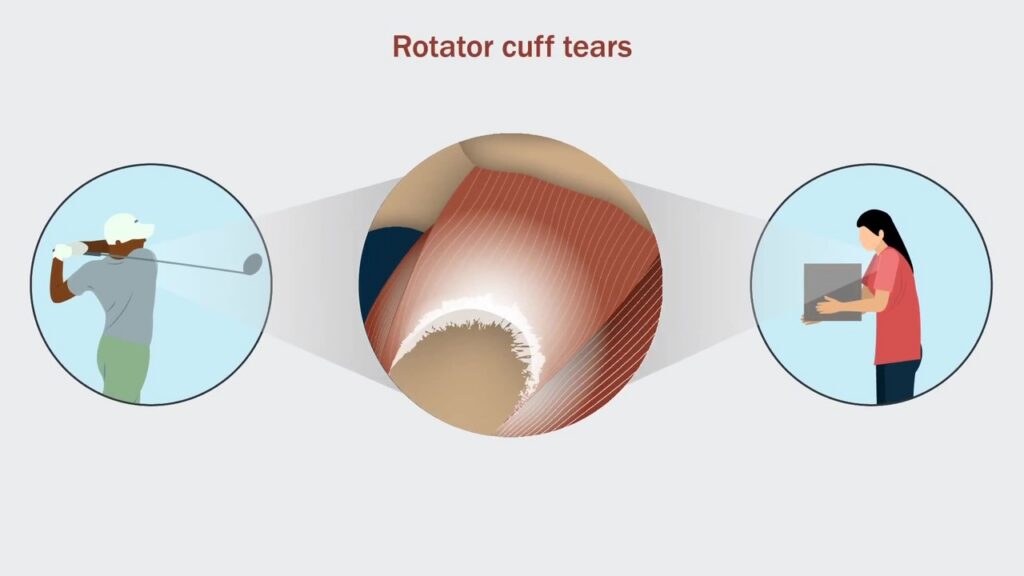Illustration of shoulder anatomy.