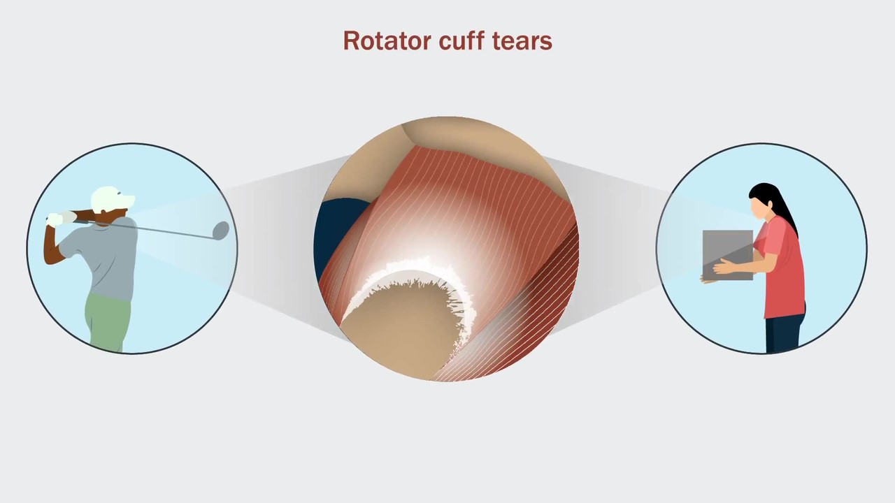 Illustration of shoulder anatomy.