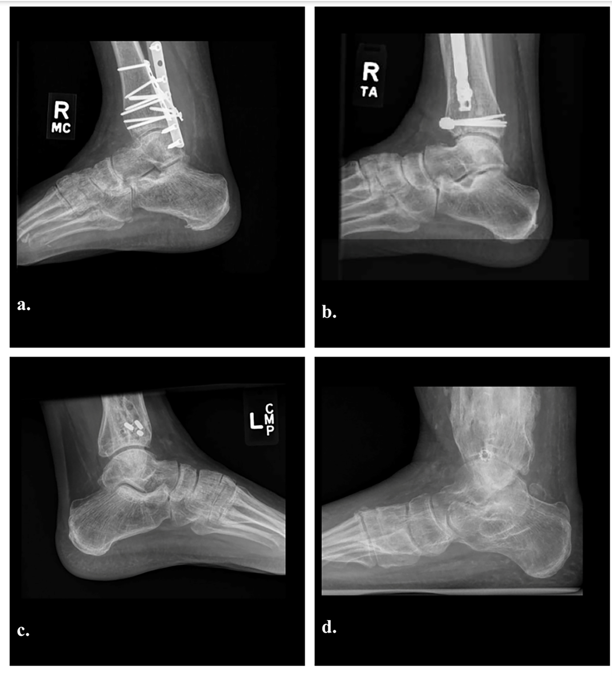 Lateral radiographs showing subtalar arthritis of Kellgren-Lawrence grade 1 (Figure 1-A), grade 2 (Figure 1-B), grade 3 (Figure 1-C), and grade 4 (Figure 1-D).