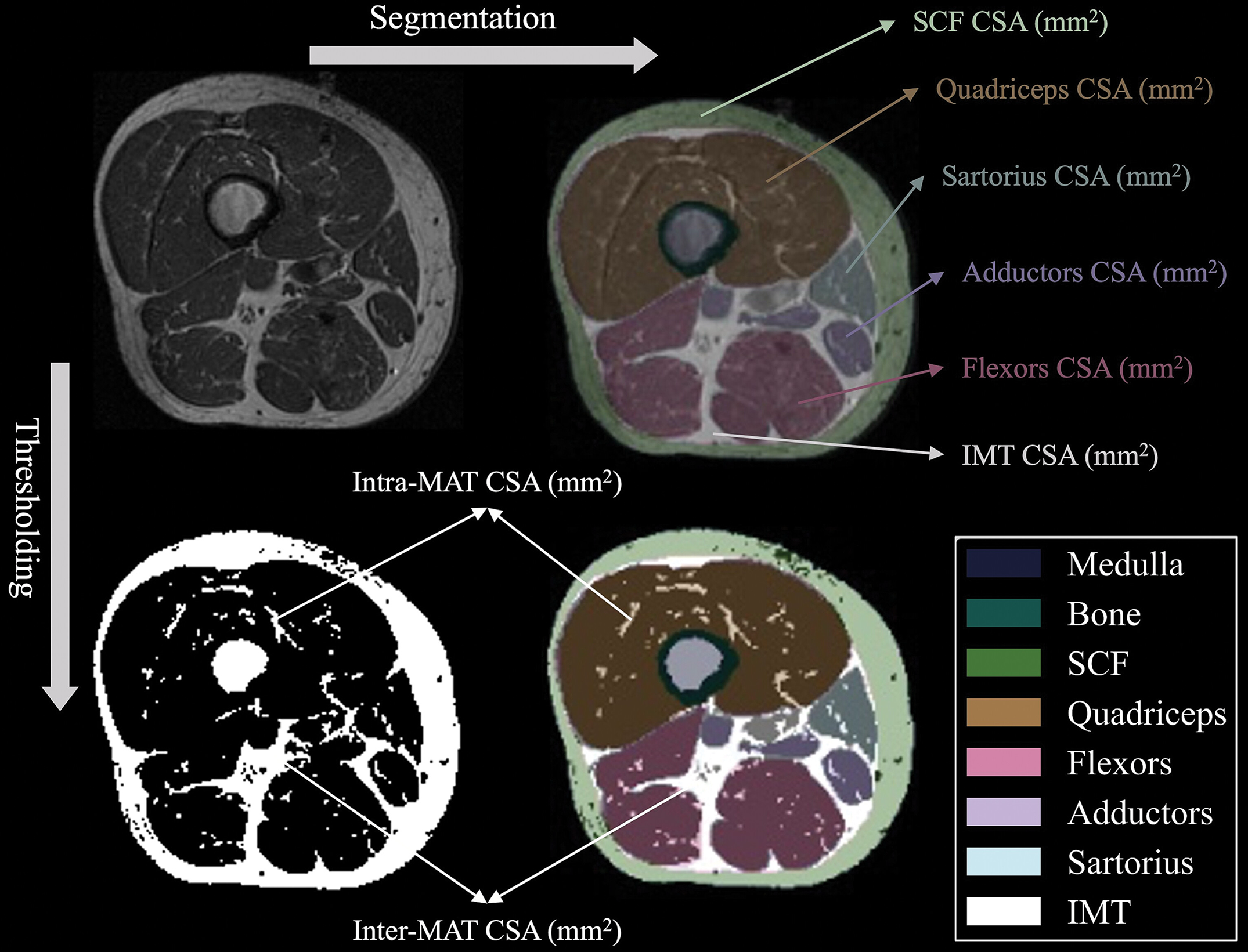 Quantitative MRI markers assessed in the study. Axial non-contrast T1-weighted MRI scan at 33% of the proximal-to-distal length of the femur in the left thigh of a 52-year-old male participant without knee osteoarthritis.