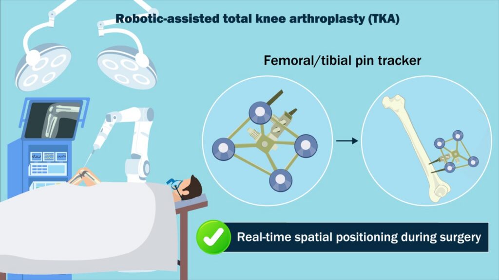 Robotic-assisted TKA